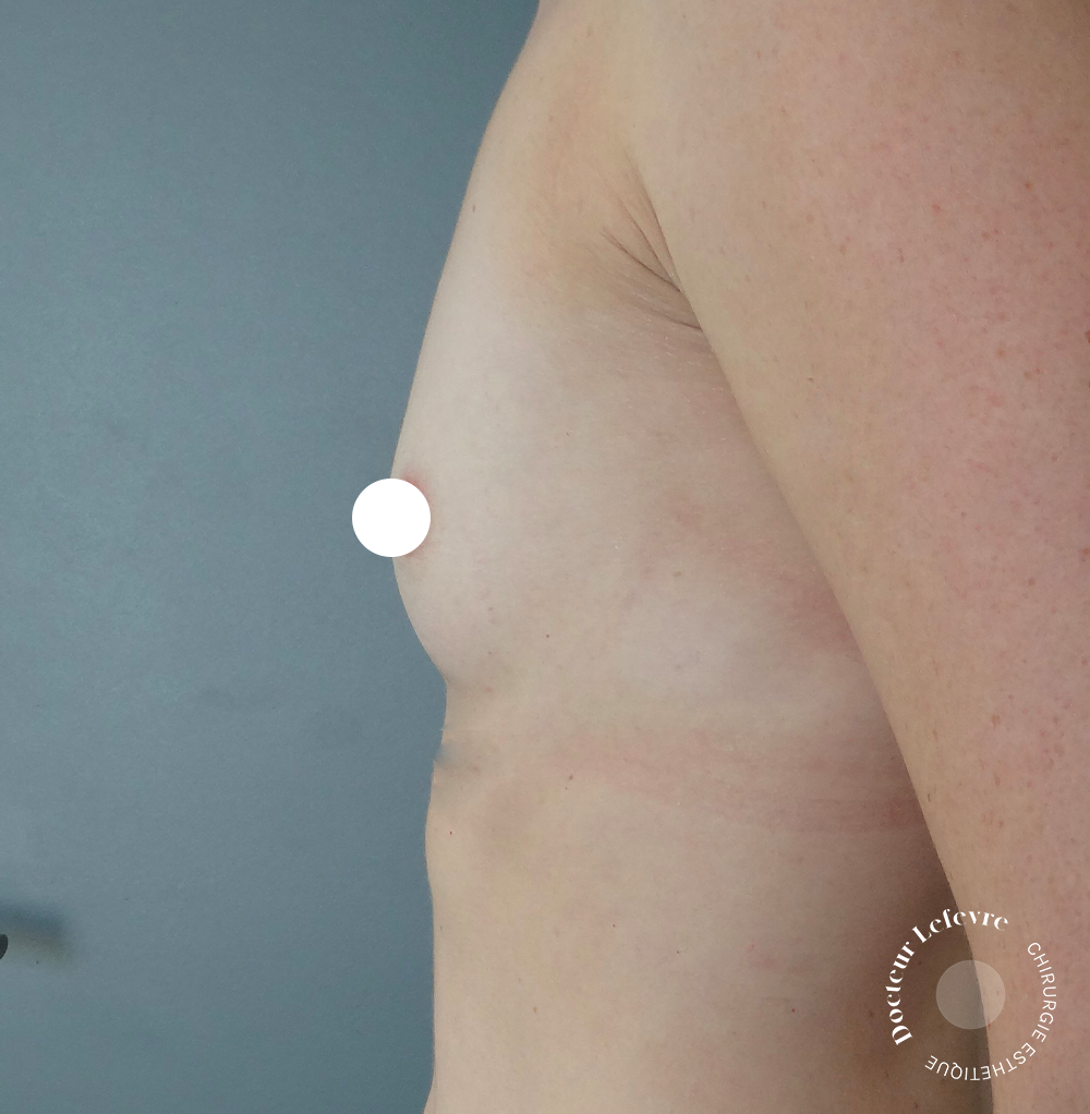 Augmentation mammaire par prothse - Docteur Lefvre  Biarritz